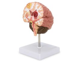 Seção Do Cerebro Com Patologia - Ce11